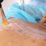 cicatrices d acné solutions